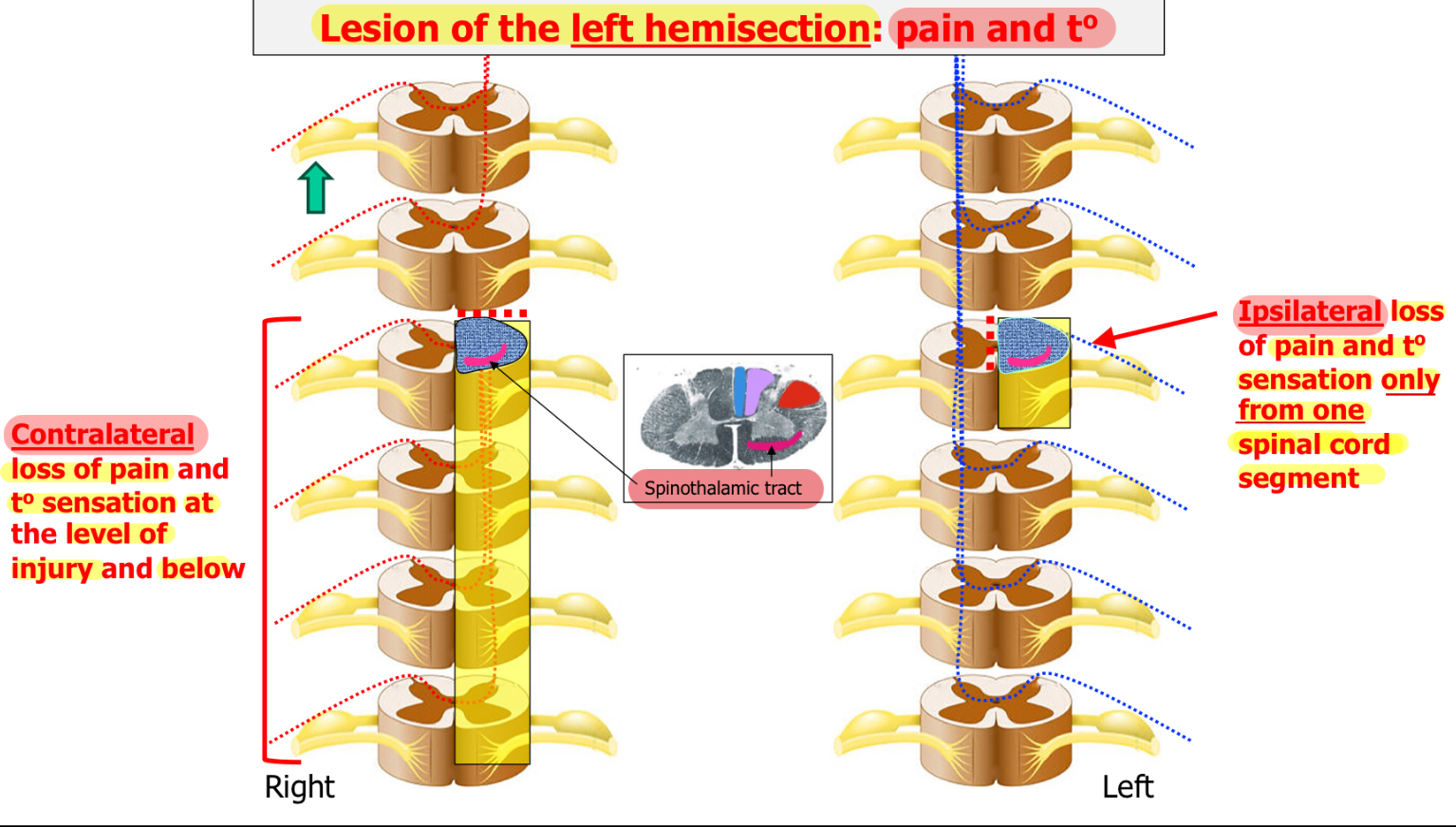 <p><u>Ipsilateral</u> =&gt; Loss of pain and temperature sensation <u>only from one spinal cord segment</u></p><ul><li><p>Because 2nd order neurons crosses midline. Sensory information from 1 dermatome will disappear. All other signals still continue and not be interrupted.</p></li></ul><p><u>Contralateral</u> =&gt; Loss of pain and sensation at <u>level of injury and below</u></p>