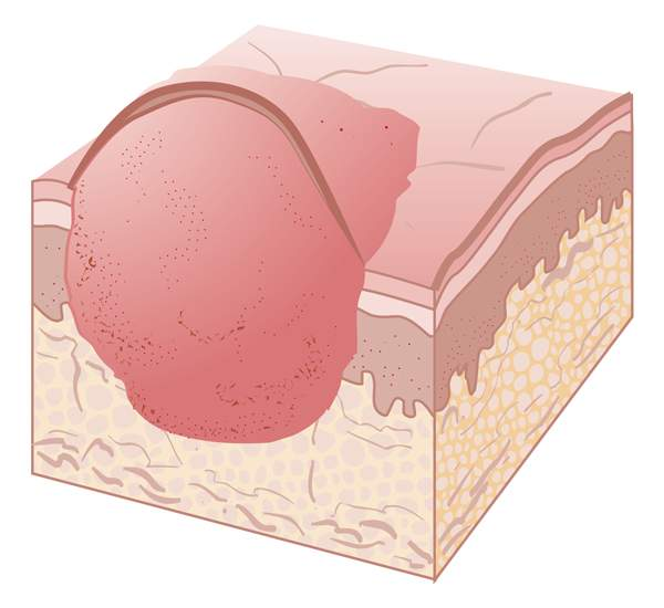 <p>solid mass larger than 1.0cm</p><p>large nodule and may be firm or soft</p><p>ex. squamous cell carcinoma</p>