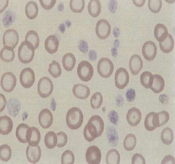 <p>What type of cell abnormality is this?</p>