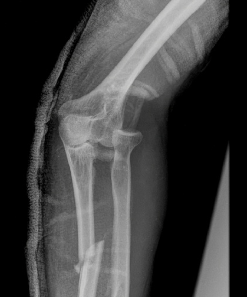 <p>A fracture of the proximal 1/3 of the ulna with dislocation of the radial head</p>