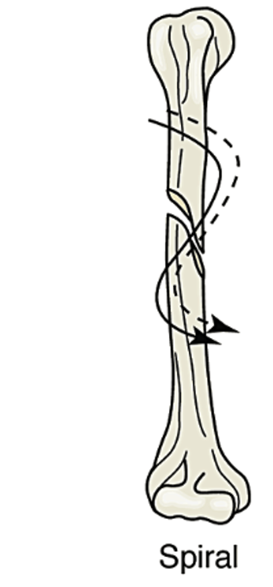 <p>fracture curves around the shaft of the bone; from a twisting motion</p>