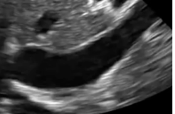 <p>How would the IVC appear in the case of fluid overload?</p><p>*cardiogenic or obstructive shock</p>