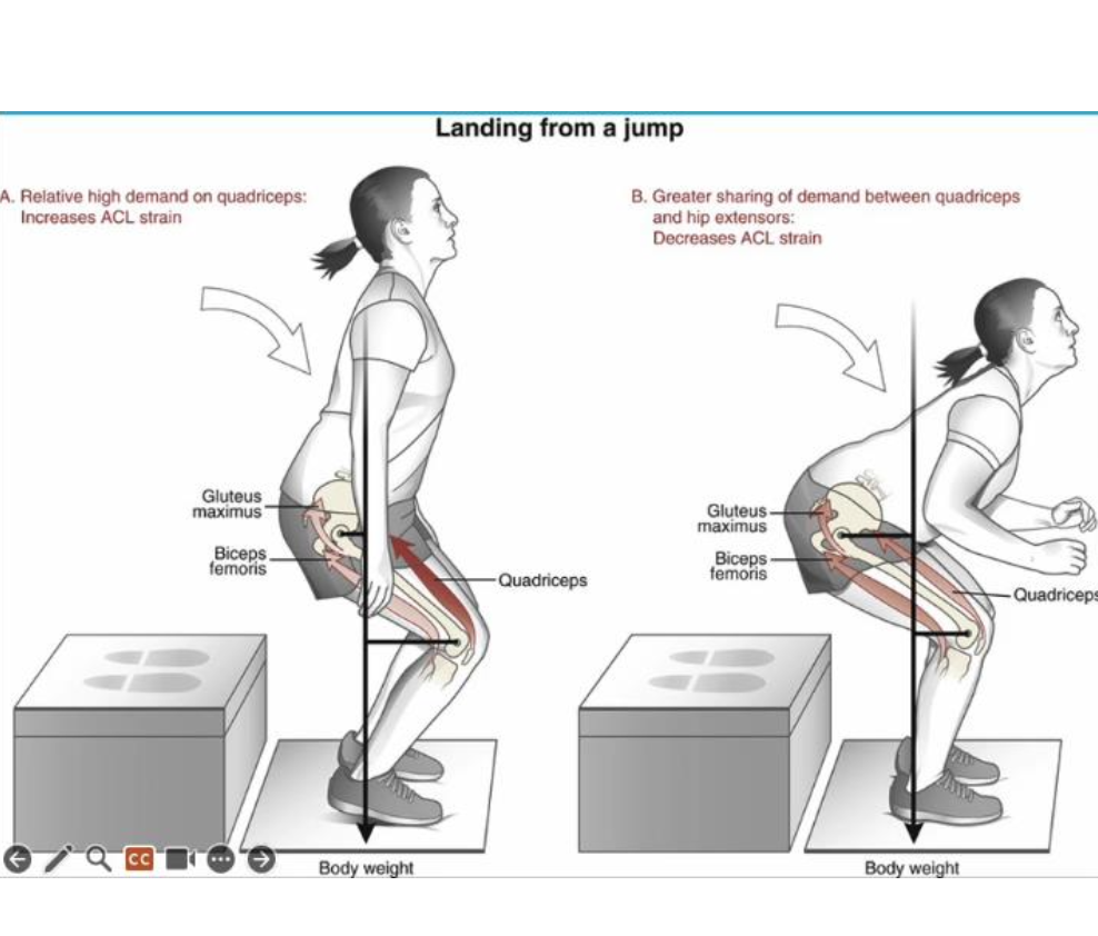 <ul><li><p><strong>Females</strong> tend to <strong>land with greater knee valgus</strong> alignment and <strong>less trunk, hip, and knee flexion</strong></p></li><li><p>they use a quad-dominant landing that strains the ACL by pulling the tibia anteriorly</p></li><li><p>3-5x more likely</p></li></ul><p></p>
