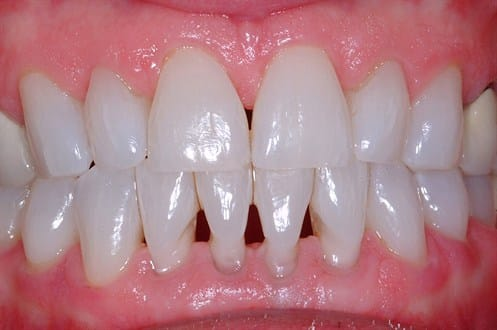 <p>Triangular-shaped spaces between two teeth, created by the sloping away of the mesial and distal surfaces.</p>