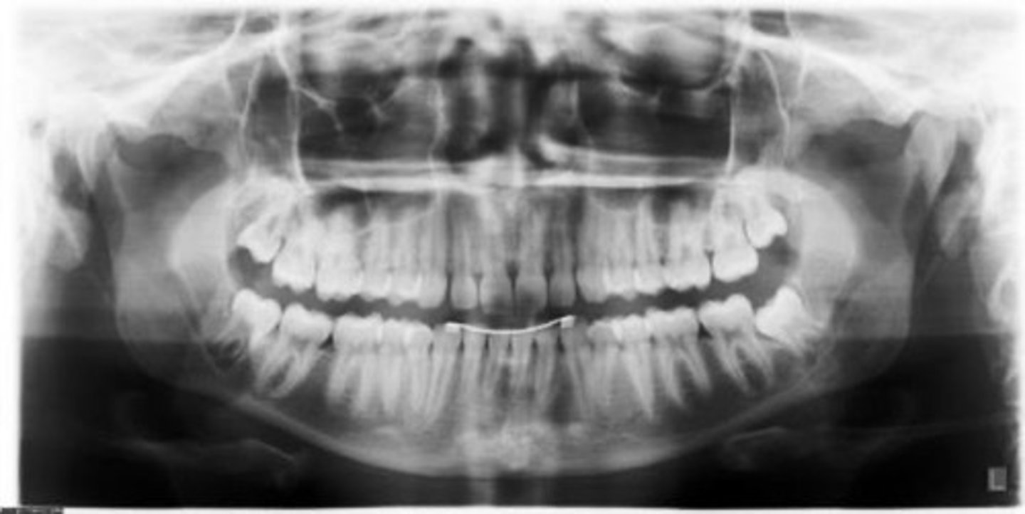 <p>Is this an ideal panoramic radiograph?</p>