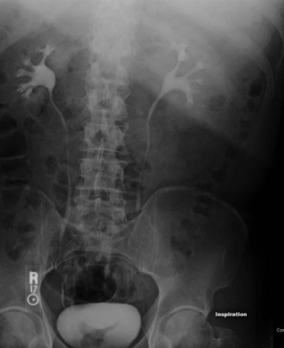 <p>XRAY using IV contrast material to assess kidney, ureters and bladder (less commonly used)</p><p><em>*CT Urogram is more common for assessing flank pain</em></p><p><em>Abdominal Radiograph</em></p>