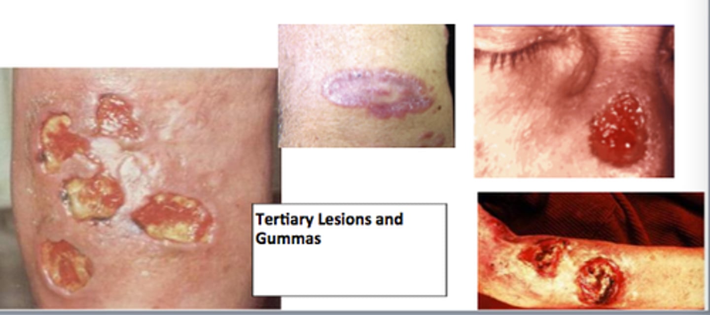 <p>Gummatous lesions (inflammatory granulomas) - mass of necrotic and inflamed tissue.</p><p>Associated with tertiary syphilis infection.</p>