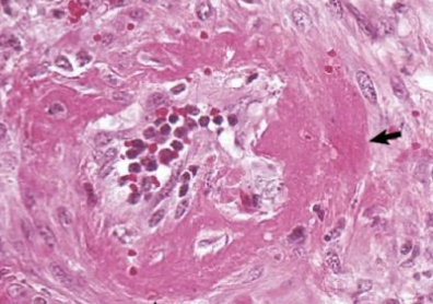 <p>Which type of necrosis occurs due to endothelial damage, accumulation of serum proteins, followed by fibrin polymerization in the vessel wall? An intense eosinophilic collar will obliterate the cell detail. It is caused by acute degeneration, inflammation of the small arteries, uremia and hypotension in dogs, is similar to hyaline degeneration but is positive for PAS and fibrin stains, and is seen alongside mulberry heart disease, edema disease, cerebrospinal angiopathy in pigs, and organic mercury toxicity.</p>