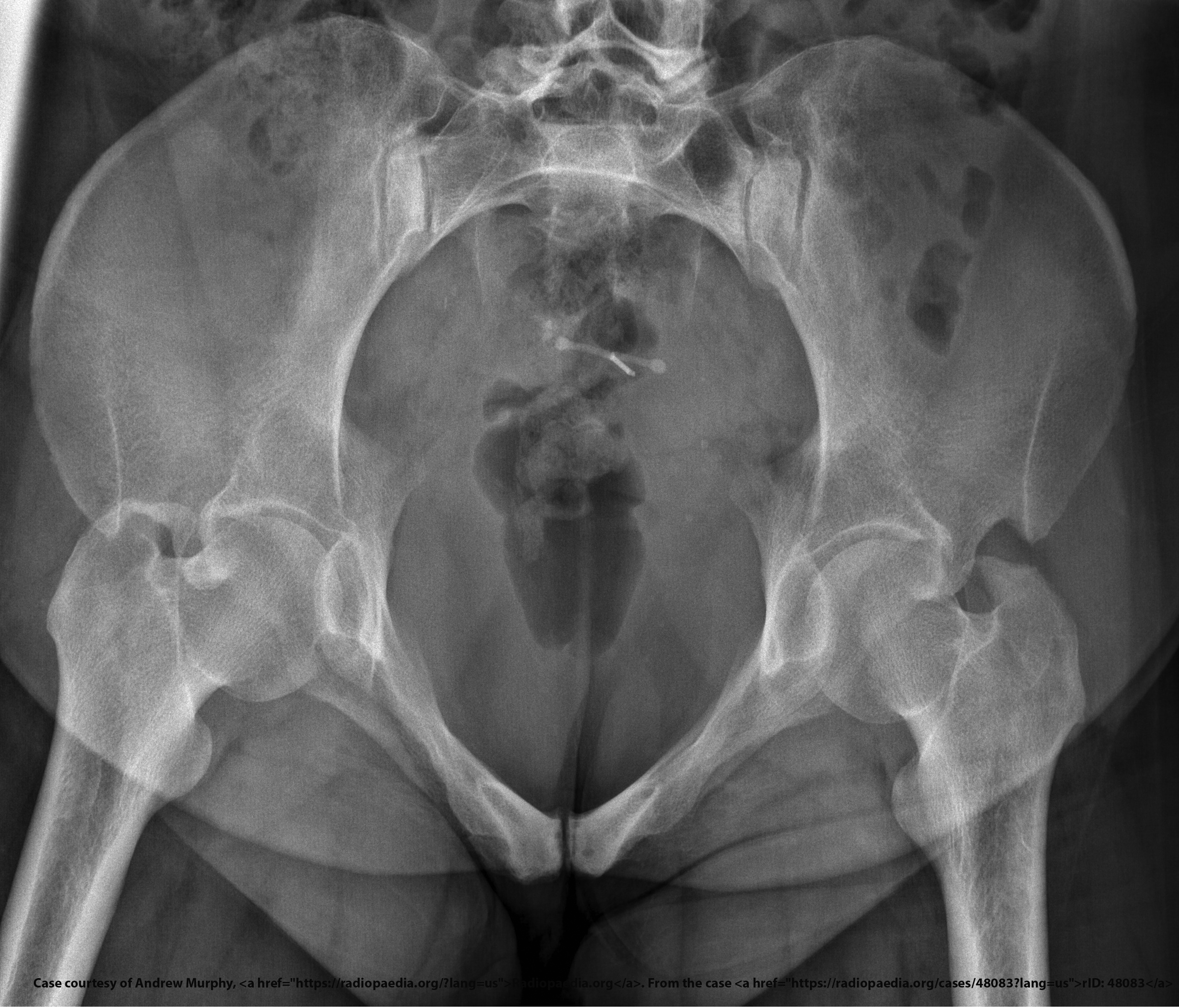 <p>Anterior/posterior displacement.</p>