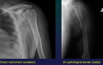 <ol><li><p>Mechanism</p><ul><li><p>direct (direct blow or bone allusion due to ligamental traction)</p></li><li><p>indirect (bending, torsion, traction, suqatting-crush)</p></li></ul></li><li><p>Terrain</p><ul><li><p>commo,, trivial</p></li><li><p>stress (fatigue)- long term microtrauma</p></li><li><p>PATHO- on preexisting bone lesion</p></li></ul></li></ol><p></p>