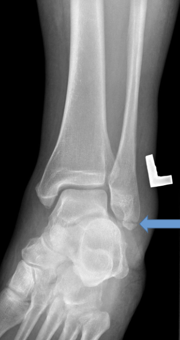<p>What type of fracture is this? (Bonus points for full explanation)</p>