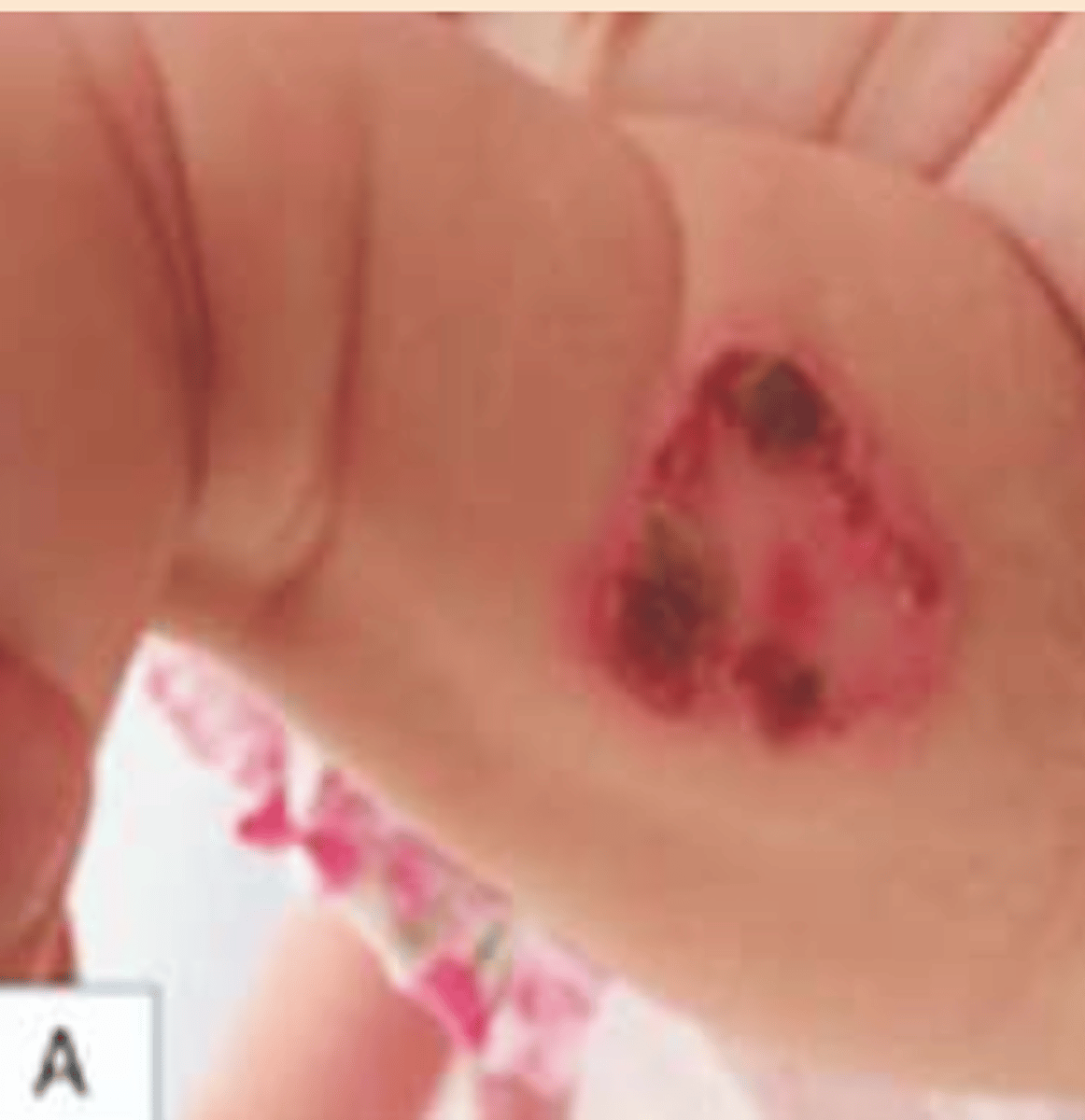 <p>¿lesión?</p><p>¿primaria o secundaria?</p>