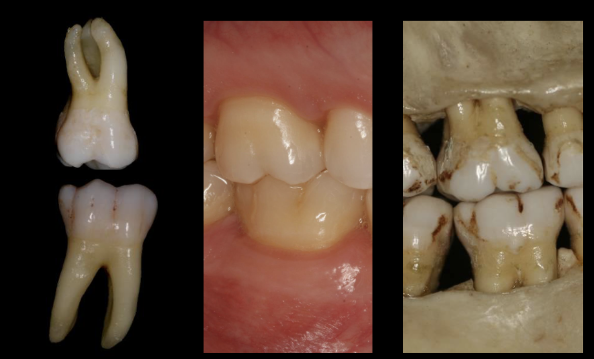 <p>anatomical: <br>crown is covered by enamel. Does not matter if it has erupted or not. <br>root is covered by cementum.<br><br>clinical: <br>crown is above gingiva<br>root is below gingiva</p>