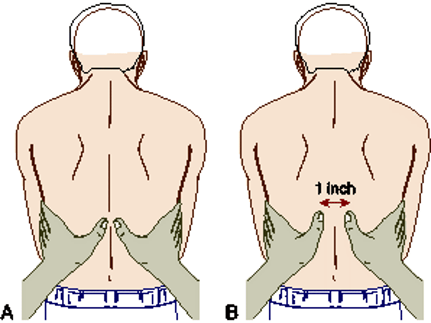 <p>ANS: C The technique for palpation for chest excursion is shown in theillustrated technique. Reduced chest movement would be noted on palpation of a patient's chest with COPD. Hyperresonance would be assessed through percussion. Accessory muscle use and tripod positioning would be assessed by inspection.</p>