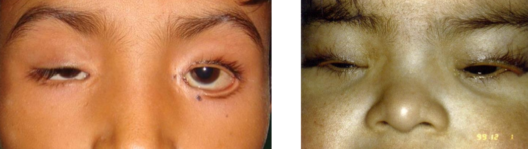 <p>What type of <strong>ectropion</strong> is caused by chromosomal abnormalities?</p><ul><li><p>Blepharophimosis</p><ul><li><p>Craniofacial disorder</p><ul><li><p>Ptosis, wide-set eyes, poorly developed superior orbital rim</p></li></ul></li></ul></li><li><p>Down’s Syndrome</p></li></ul><p></p>