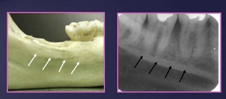 <p>located on the lingual surface of the mandible , extending from the third molar area to premolar region</p>