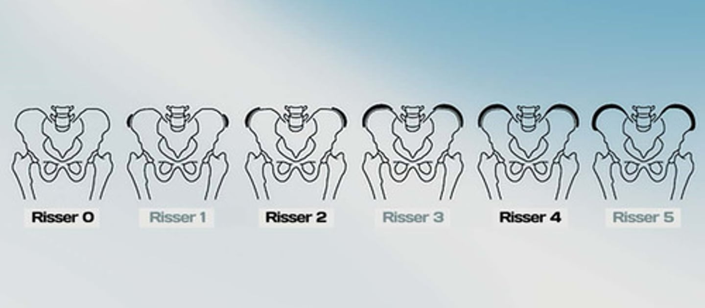 <p>Risser = 0: PHV not reached</p><p>Risser >0: PHV has been reached</p><p>0: 0% ossification (no line)</p><p>1: 25% ossification</p><p>2: 50% ossification</p><p>3: 75% ossification</p><p>4: 100% ossification</p><p>5: full fusion to ilium (no line)</p>