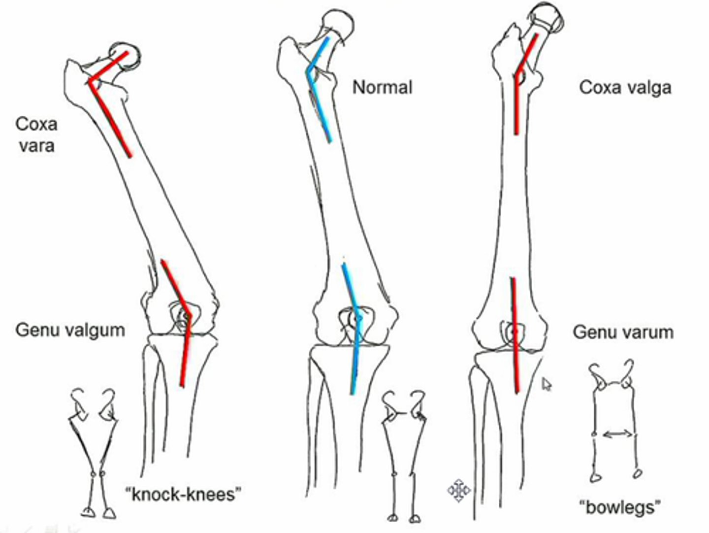 <p>Coxa Valga</p><p>Higher risk of hip arthritis (170 degrees)</p><p>normal position 125 degrees</p><p>Coxa Vara</p><p>Higher risk for femoral neck fractures (100 degrees)</p>
