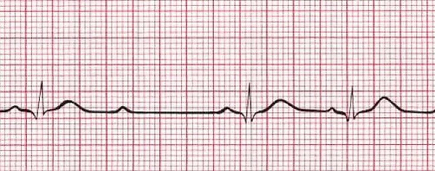 <p>What does this EKG show</p>