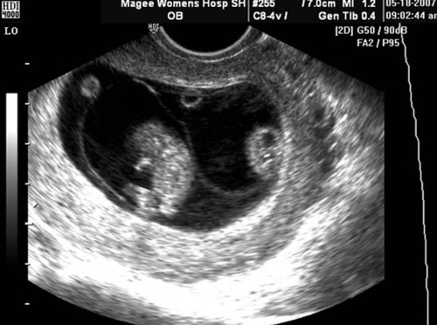 <p>75% of monozygotic twins</p><p>Divides between 4-7 days</p><p>25% mortality rate</p>