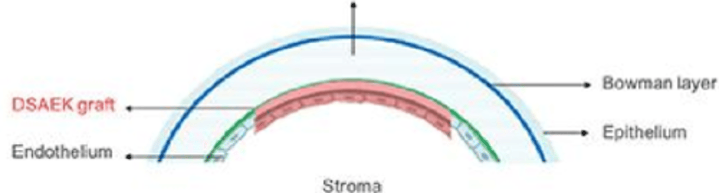 <p>What is a Descemet's stripping automated endothelial keratoplasty (DSAEK) and when is it used?</p>