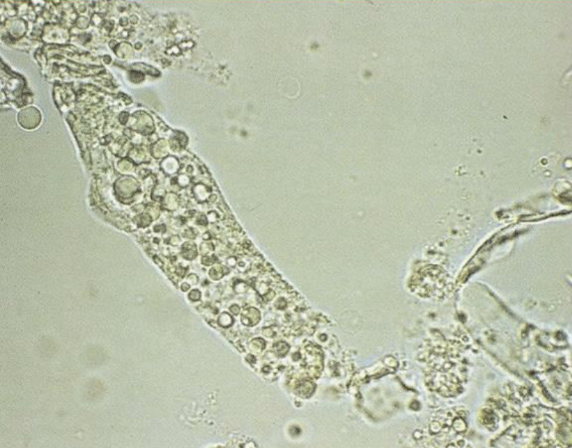 <p>What type of cast is this?</p><p>What species will you see this as normal in?</p><p>When will you see large numbers?</p>