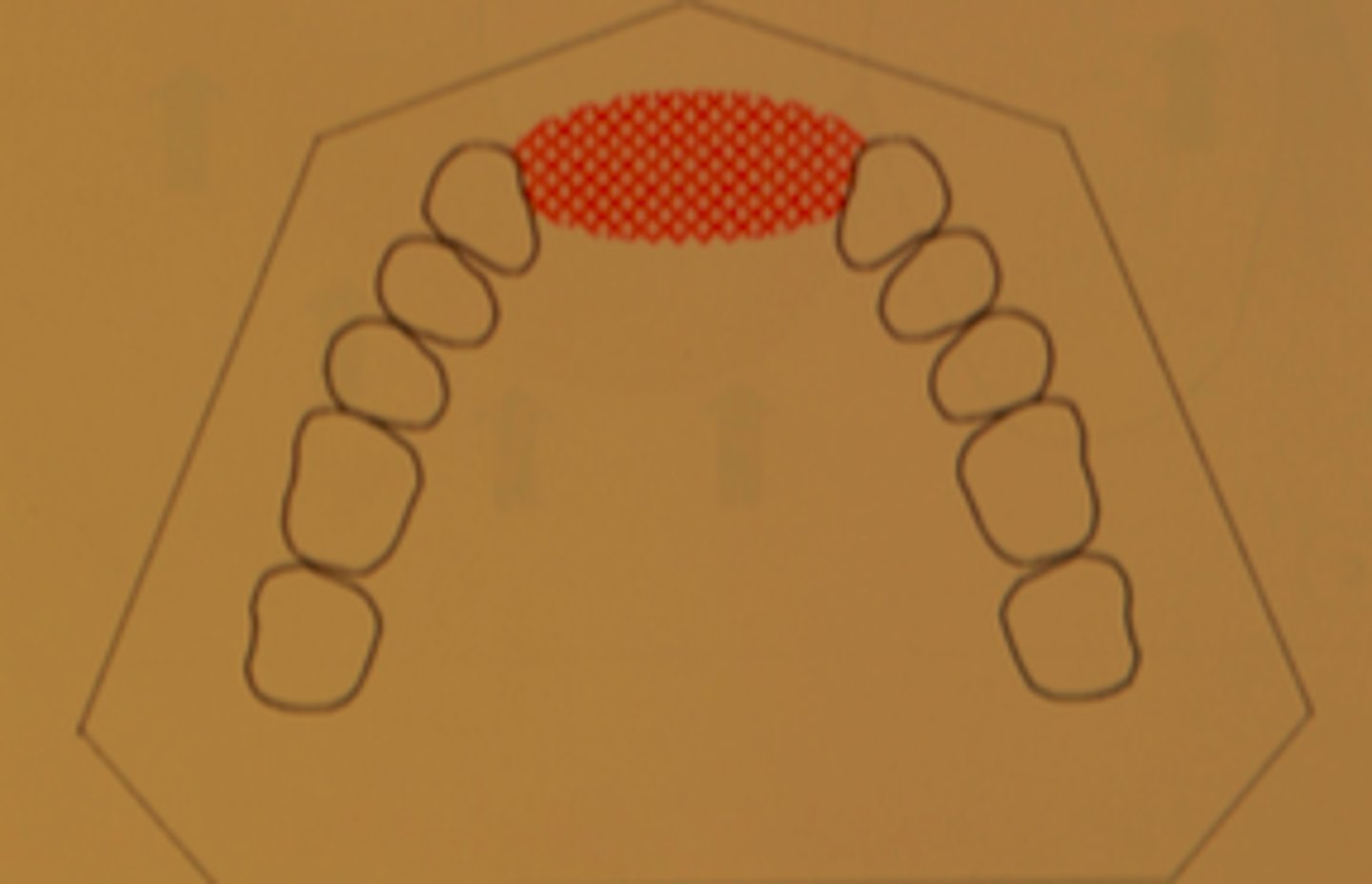 <p>Kennedy classification:</p><p>- A single but bilateral (crossing the midline) edentulous area located anterior to the remaining natural teeth.</p>