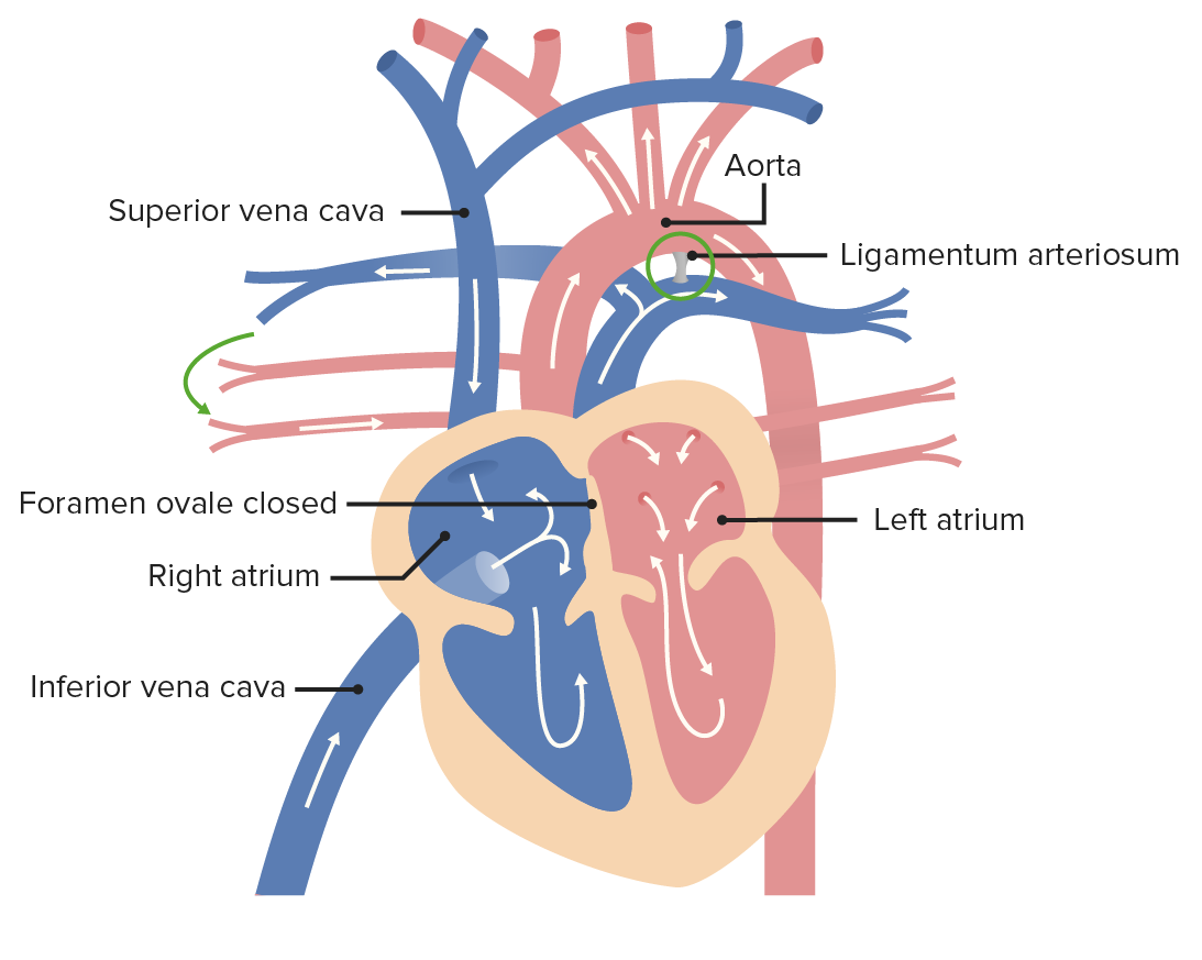 <p>ligamentum arteriosum</p><ul><li><p><span>remnant of the fetal ductus arteriosus, a vessel connecting the pulmonary trunk to the aorta in the developing fetus</span></p></li><li><p><span>thickening of tunica media, distal to ligamentum arteriosum leads to <u>aortic coarction</u></span></p></li></ul><p></p>