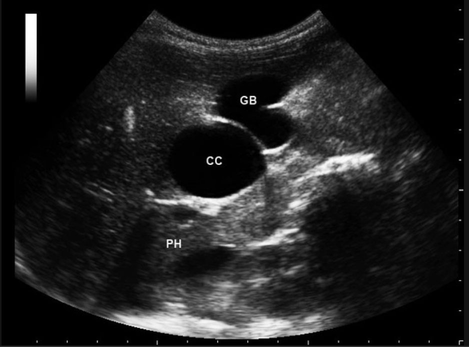 <p>C<span>ongenital cystic dilation of biliary ducts </span></p><p><span>Anechoic mass near porta hepatis; fusiform or saccular dilation of CBD</span></p>