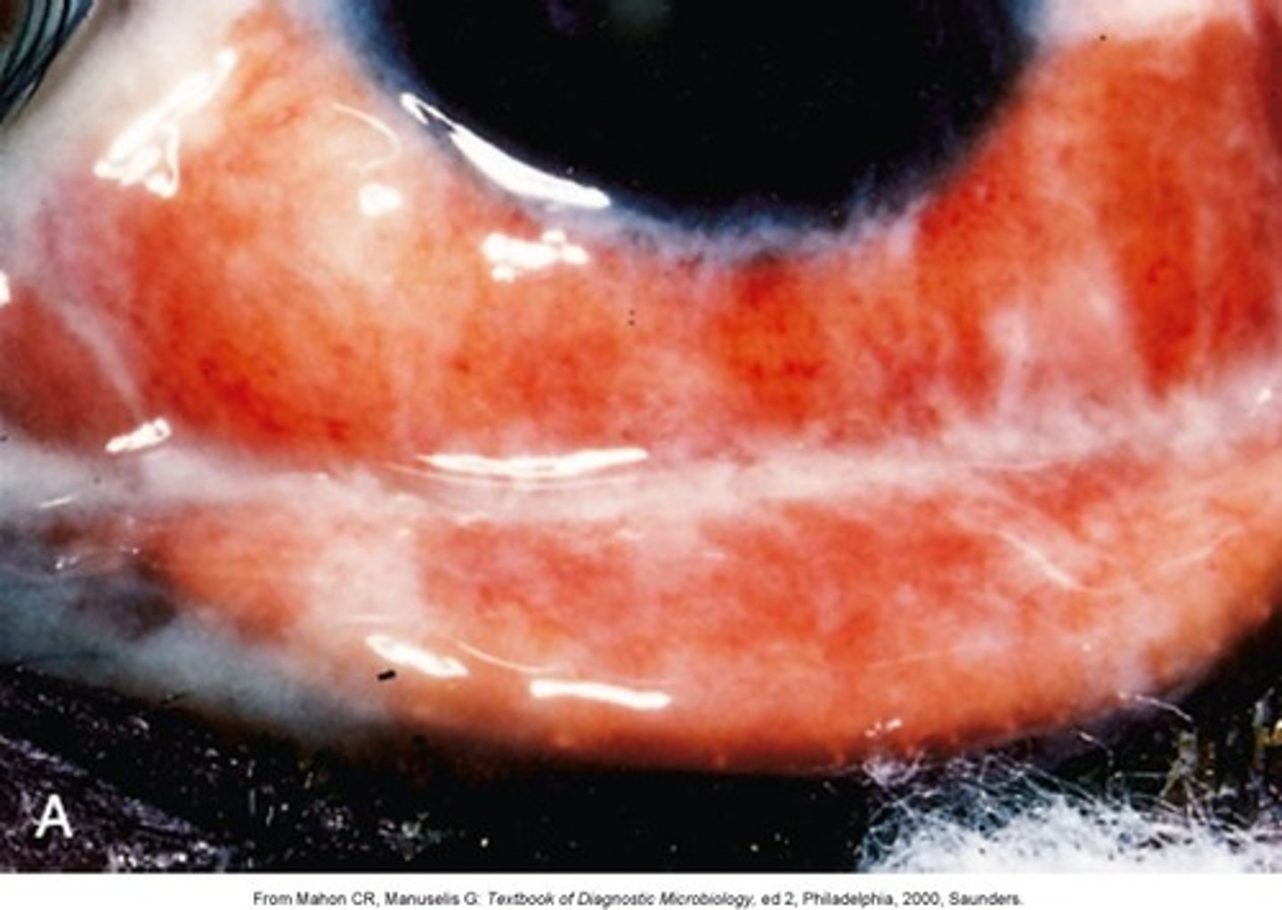 <p>Gonococcal Conjunctivitis</p>