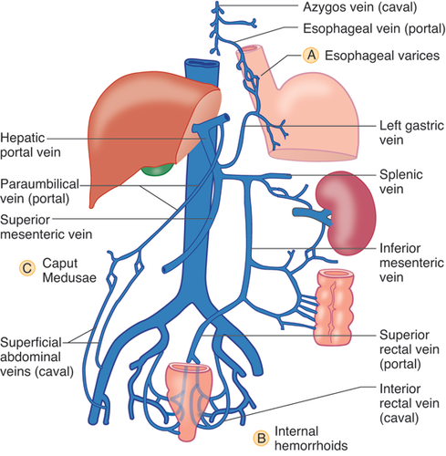 *vv. oesophageales - vv. gastrica*
 • Varicer i oesophagus pga. trykstigning
 • vv. oesophageales dræneres også til v. cava sup

*vv. paraumbilicales - vv. epigastrica*
 • Kontakt med v. portae grene i leveren
 • Caput medusa

*v. rectalis sup - v. rectalis med. + inf*
 • Giver hæmorider

Sekundære retroperitoneale organer
 • Doudenum
 • Pancreas
 • Colon as + des
-> Disse organer kan også drænere til v. lumbalis på bagerste kropsvæg

-------------

*Ved leversygdom øges trykket i vena portae. Angiv lokalisationen af porta-cava anastomoser og beskriv konsekvenserne ved leversygdom med portal hypertension.*
Sv.: 
1. Vv. Gastricae danner anastomoser med de nederste esophagusvener som tømmer sig i azygosvenerne. Øget tryk i vena portae kan medføre dilatation af de submucøse veneplexer distalt i esophagus og dermed til dannelse af esophagus varicer. Hvis disse brister kan opstå livstruende blødninger. 

2. Vv. rectalis superiores danner anastomoser primært med vv. rectalis inferiores, som tømmer sig i vv. iliacae int. Anastomoserne ligger i submucosa i nederste del af rectum og analkanalen. Dilatation fører til dannelse af hæmorroider. 

3. Vv parumbilicales (små subcutane vener) på abdomens forside anastomoserer med venerne omkring ligamentum falciforme til i v portae. Disse anastomoserer i subcutis med bl.a. vv epigastricae. Dilatation kan føre til dannelse af "caput Medusae", der ses som snoede veneplexer radierende ud fra umbilicus. Ses sjældent. 

4. Venerne der drænerer de retroperitoneale dele af mavetarmkanalen og pancreas danner talrige små anastomoser med venerne i bagvæggen af abdomen der drænerer til azygos/cava systemet