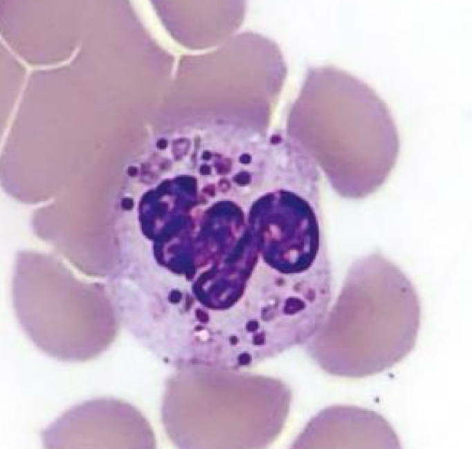 <p>Neutrophil, Chediak-Higashi syndrome</p>