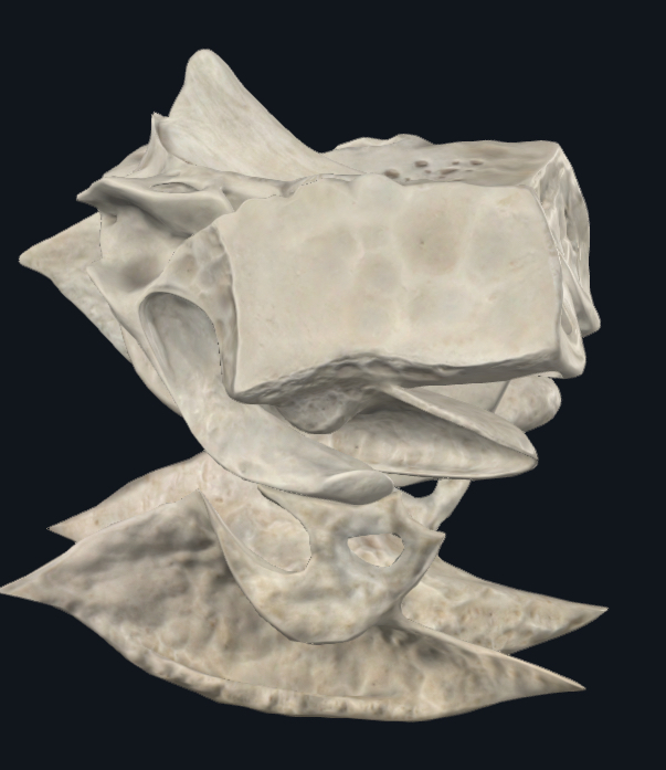 <p>Labyrinthe éthmoïdal et cornet inférieur</p>