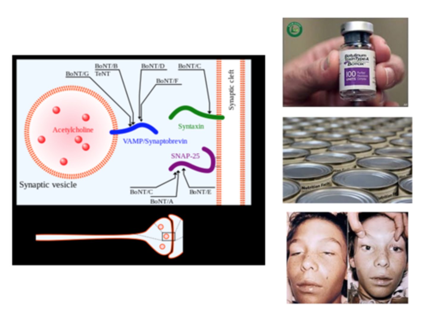 <p>Botulinium toxin - these people become paralysed</p>
