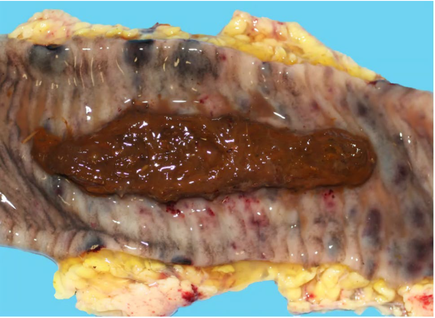 <p>What is a microscopic feature?</p><p>A-Crypt dilation</p><p>B-Crypt herniation</p><p>C-Crypt necrosis</p><p>D-Crypt hyperplasia</p>