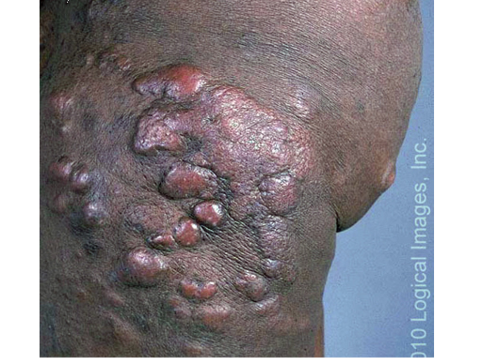 <p>cutaneous T cell lymphoma, form of non-hodgkin lymphoma that presents as patches, plaques, tumors, or erythroderma</p><p>unknown cause </p>