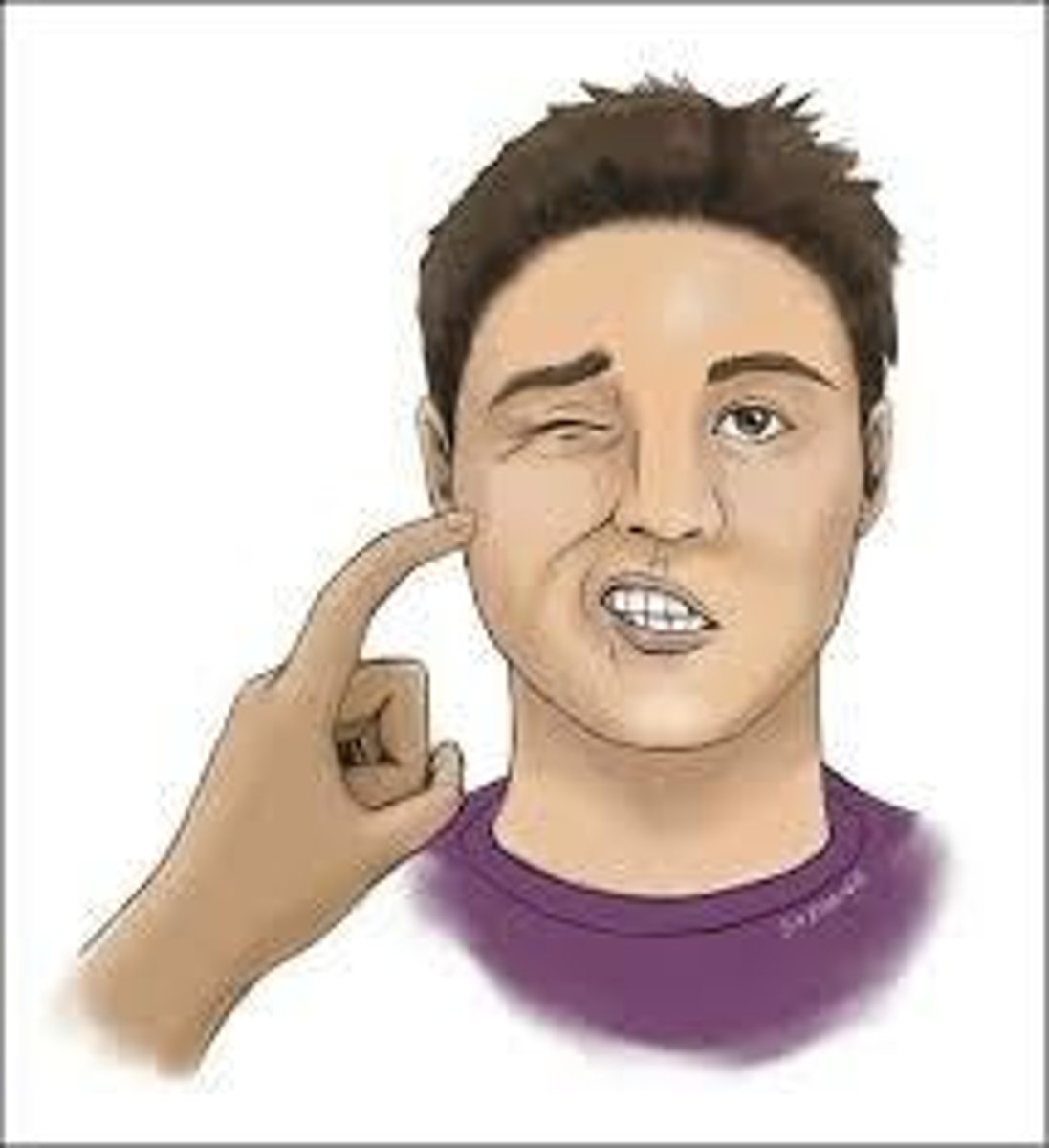 <p>-oral manifestation of hypoparathyroidism</p><p>-twitching of upper lip when facial nerve is tapped just below zygomatic process</p>