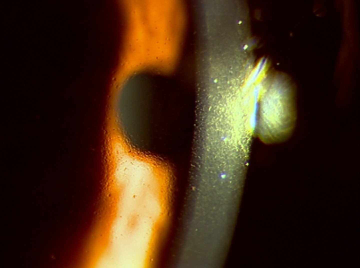 <p>occur in central cornea and indicate abnormal function of endothelium. Indicate endothelial dystrophy</p><p>-Hassall-Henle warts can resemble corneal guttae but occur in peripheral cornea and is a normal occurrence with age</p>
