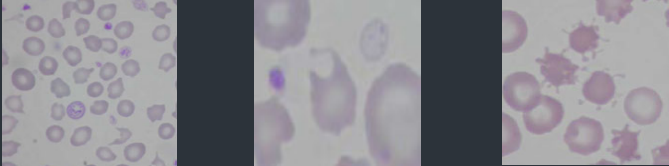 <p>Left - Schizocytes</p><p>Middle - keratocytes</p><p>Right - Acanthocytes</p><p>Form when blood forced to flow through an altered vascular channel or turbulent blood flow.</p>