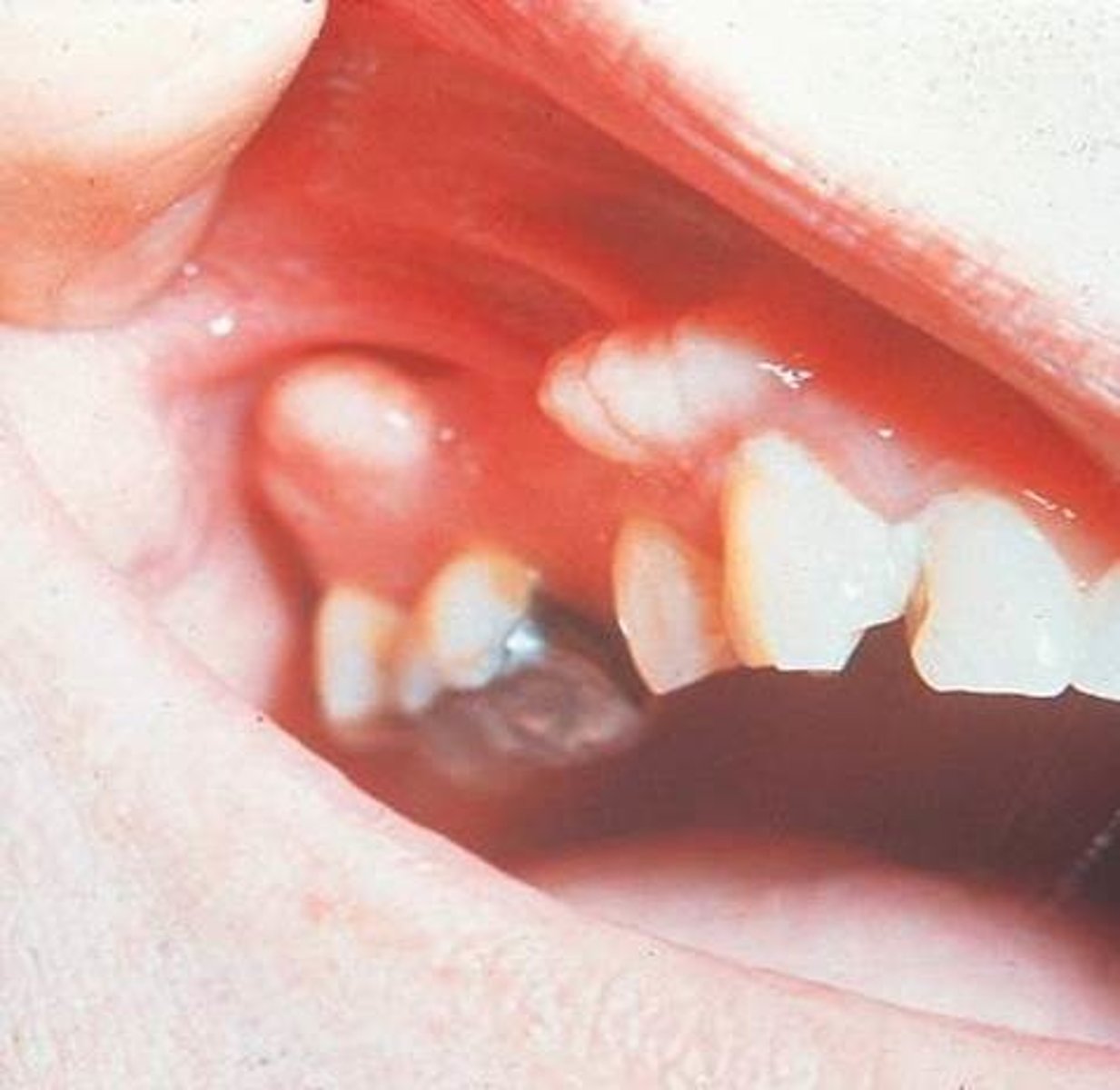 <p>maxillary exostosis</p>