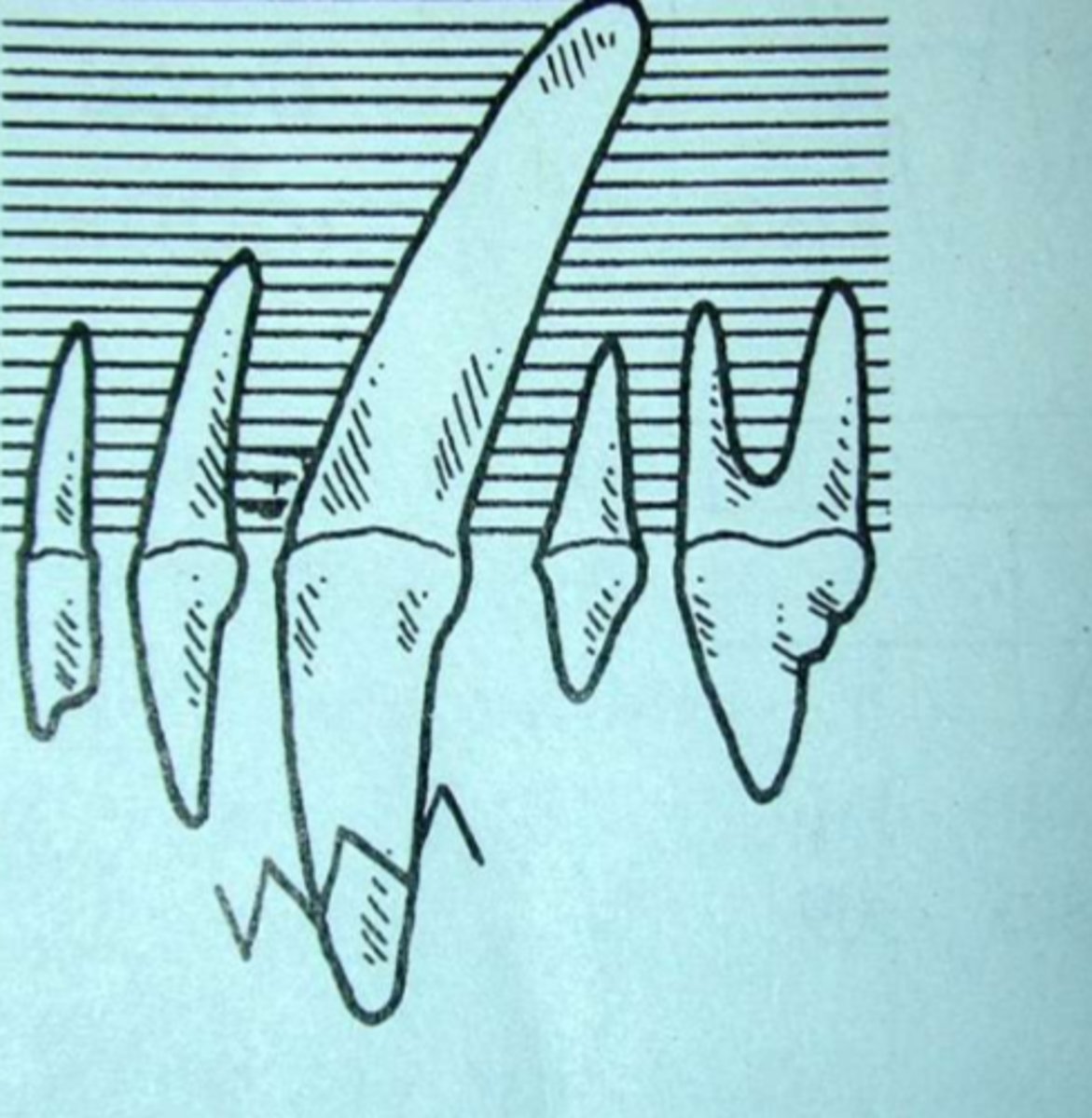<p>When you see this on a dental record, what does it mean?</p>