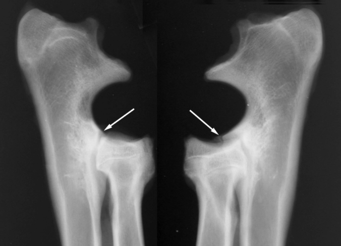 <p><strong>incongruency </strong></p><ul><li><p><span style="color: blue">mismatch/misalignment between the surfaces making up the joint, which leads to joint dysfunction or pain</span>. </p></li><li><p>relevant in the evaluation of joint disorders, like osteoartiritis or post-traumatic changes. </p></li><li><p>characterization: difference in joint space witdth between the two sides of a joint, bone alignment difference, sclerosis, cyst formation, osteophytes (bone spurs), irregularities.</p></li></ul><p></p>