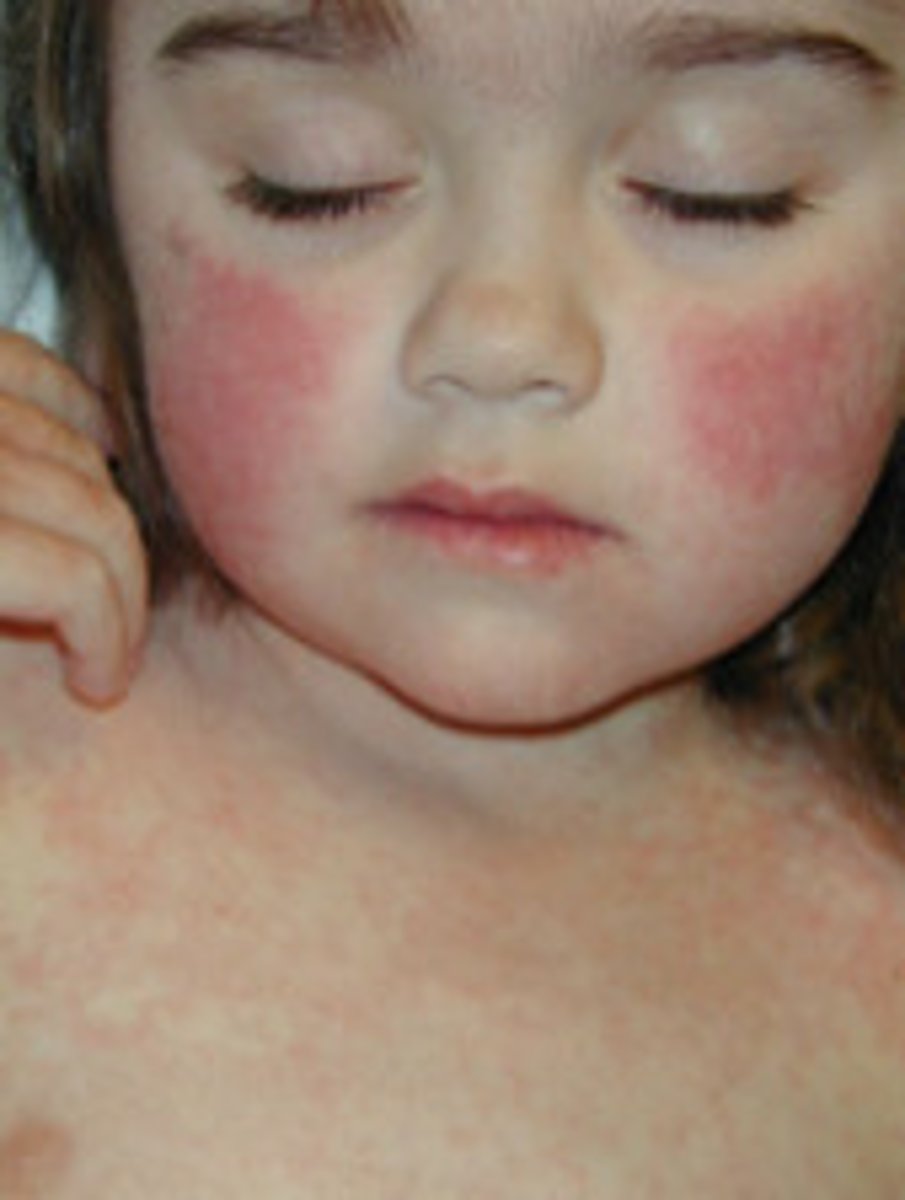 <p>Red hue, increased blood flow<br><br>Picture: "slapped cheeks" or erythema infectiosum (fifth disease)</p>