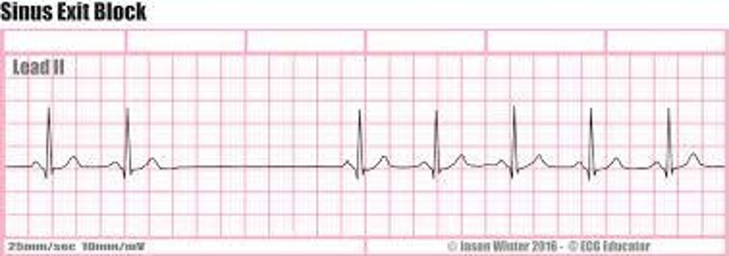 <p>All the same like NSR except irregular rhythm because of pause(s) caused by S.A. block and rate varies depending on electrical activity of S.A. Node</p>