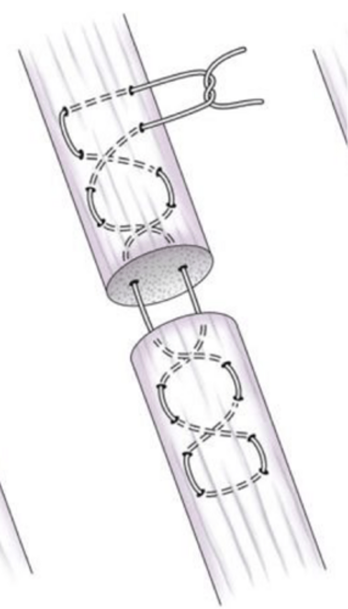 <p>what ligament/tendon suture pattern is shown here that is has fallen out of favor as it cuts off blood supply</p>