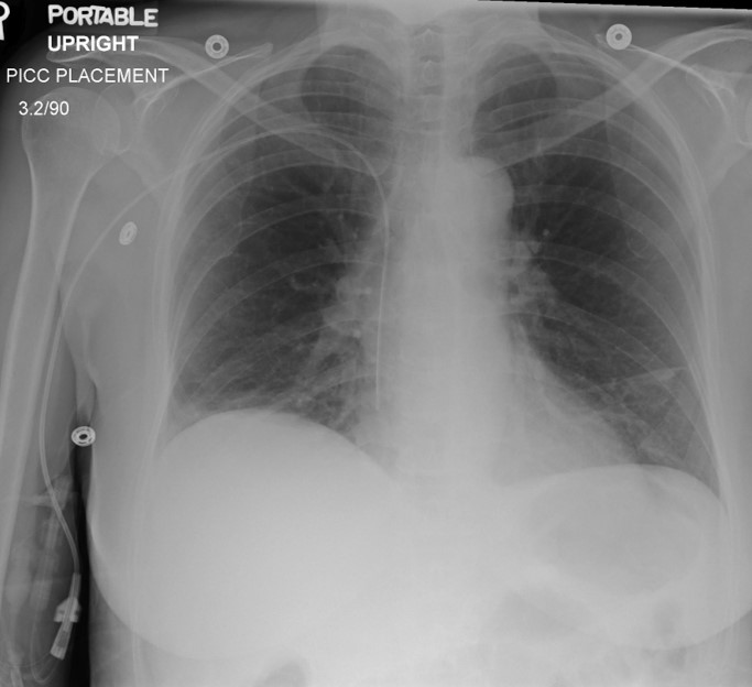<p>Where is a PICC line inserted?</p>