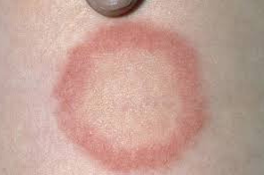 <ul><li><p><strong>Fungal Infection</strong></p></li><li><p><strong>Common Sites:</strong></p><ul><li><p>Hands</p></li><li><p>Skin</p></li><li><p>Nails</p></li></ul></li><li><p><strong>Dry, Scaly Patches:</strong></p><ul><li><p>May be circular with a central clearing.</p></li><li><p>Often seen in immunocompromised individuals.</p></li></ul></li><li><p><strong>Treatment:</strong></p><ul><li><p>Keep the area clean and dry.</p></li><li><p>Oral antifungals such as <em>Griseofulvin</em>.—monitor liver enzymes.</p></li><li><p>Check pets and family members for infection.</p></li></ul></li></ul><p></p>