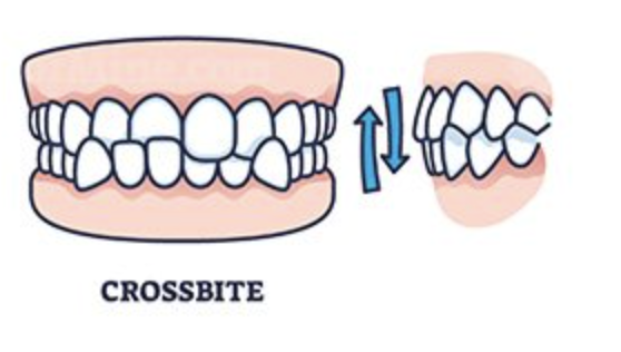 <p>a tooth or teeth that are out of alignment in a bucco/lingoversion</p><ul><li><p>Crossbite can exist between any number of teeth (even just 1) </p></li></ul><p></p>