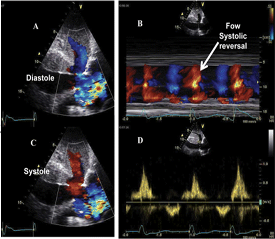 <p><span style="font-family: &quot;Calibri Light&quot;">On the spectral waveform, this systolic flow will appear a_______</span></p>