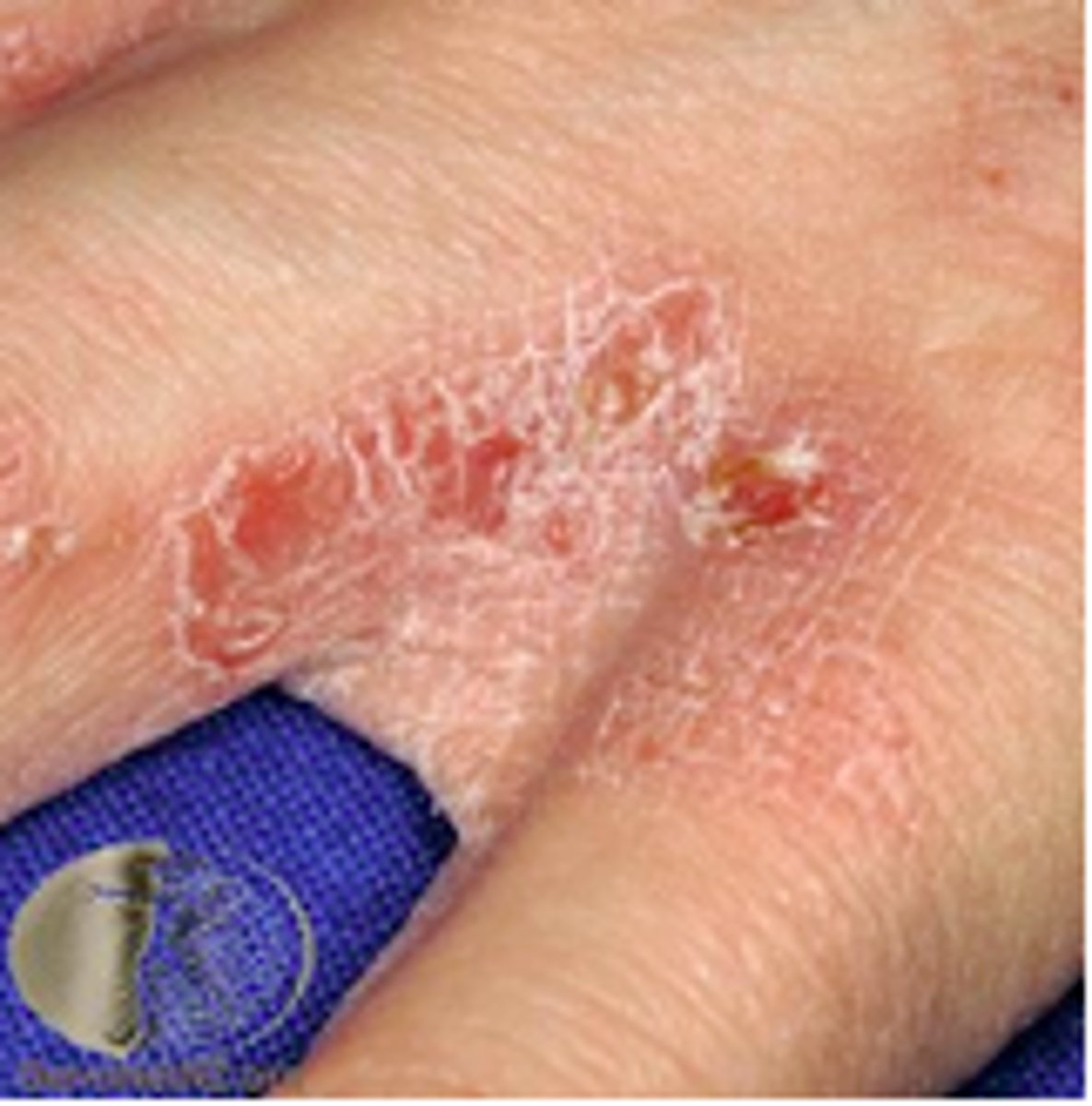 <p>Scabies</p>